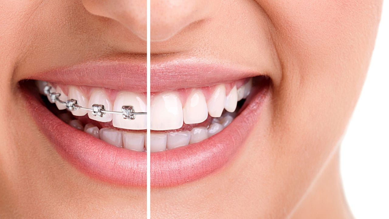 How long does it take to get braces off? Everything You Need to Know