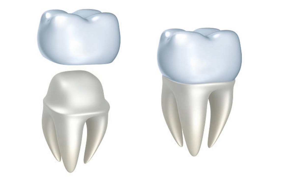 How Long Can a Temporary Crown Last Before Trouble Starts?